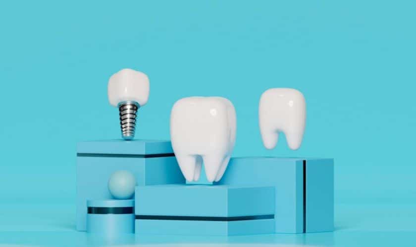 dental implant in Brentwood